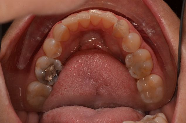 Invisalign: Case 12 - Before