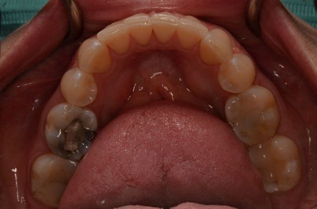 Invisalign: Case 12 - After