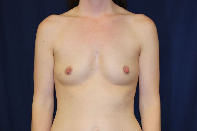 Breast Augmentation*: Case 56 - Before