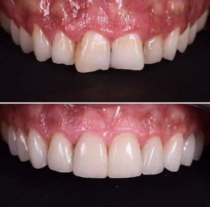 Before and Afters: Case 2 - 10 Veneers