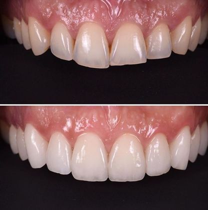 Before and Afters: Case 2 - 10 Veneers