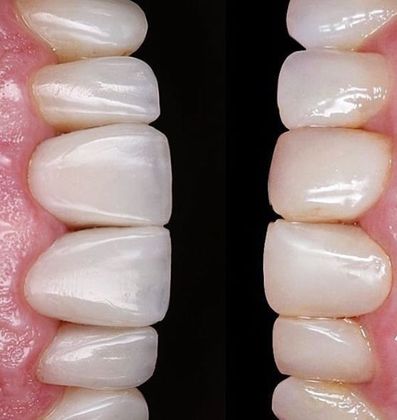 Before and Afters: Case 2 - 6 Veneers