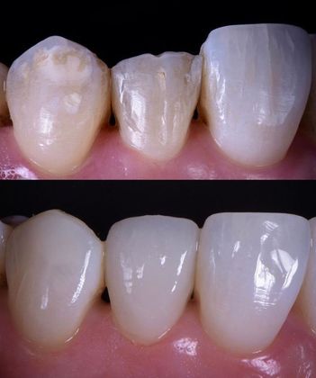 Before and Afters: Case 2 - 3 Veneers