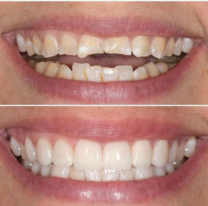 Before and Afters: Case 2 - Crowns and Veneers Combo