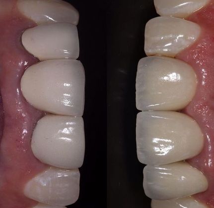 Before and Afters: Case 2 - 4 Crowns