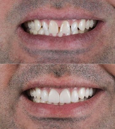 Before and Afters: Case 2 - 6 Veneers
