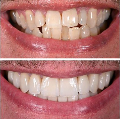 Before and Afters: Case 2 - 16 Veneers 10 Upper 6 Lower