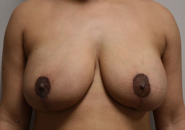 Breast Revision: Case 138 - After