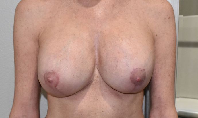 Breast Revision: Case 139 - After