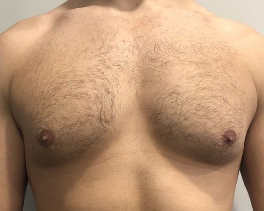 Male Breast Reduction Case 4 Gynecomastia, Monroe, CT - Before