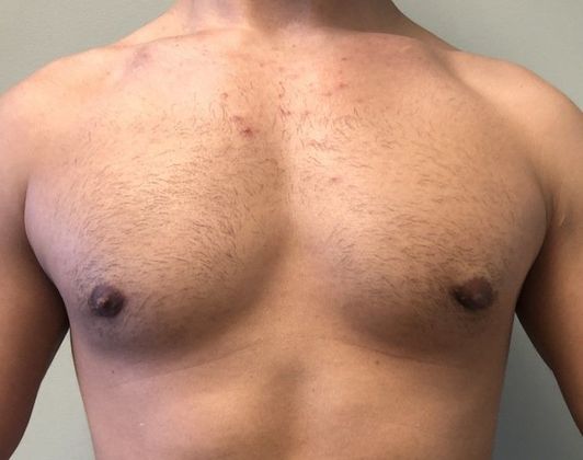 Male Breast Reduction Case 4 Gynecomastia, Monroe, CT - After