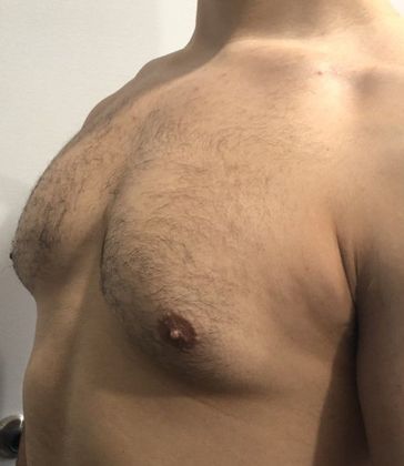 Male Breast Reduction: Case 4 Gynecomastia, Monroe, CT - Before