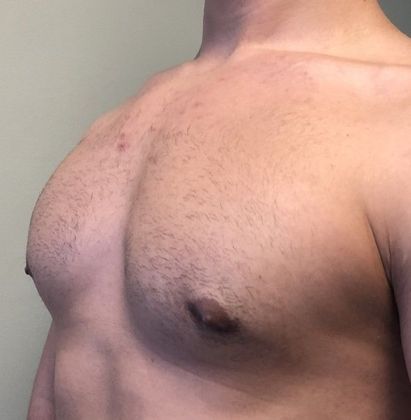 Male Breast Reduction: Case 4 Gynecomastia, Monroe, CT - After