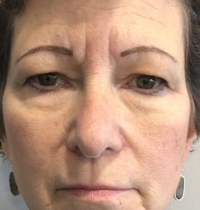 Eyelid Lift: Case 22 Upper Eyelid Lift Norwalk, CT - Before