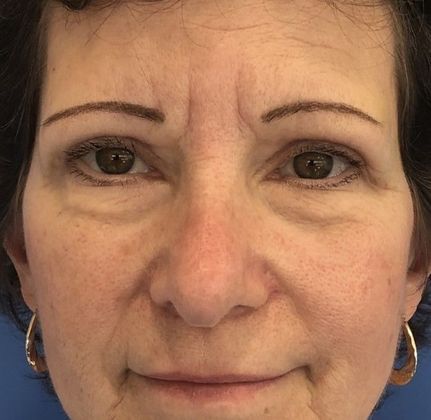 Eyelid Lift: Case 22 Upper Eyelid Lift Norwalk, CT - After