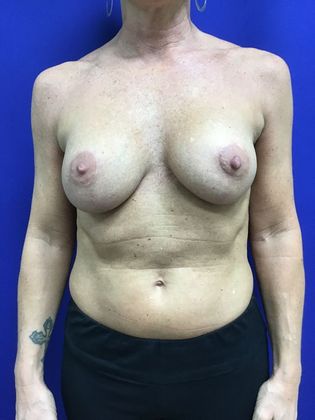 Breast Lift / Mastopexy: Case 35 (22596) - Early postop