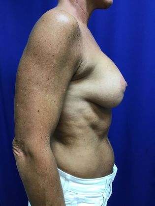 Breast Lift / Mastopexy: Case 35 (22596) - After, one year
