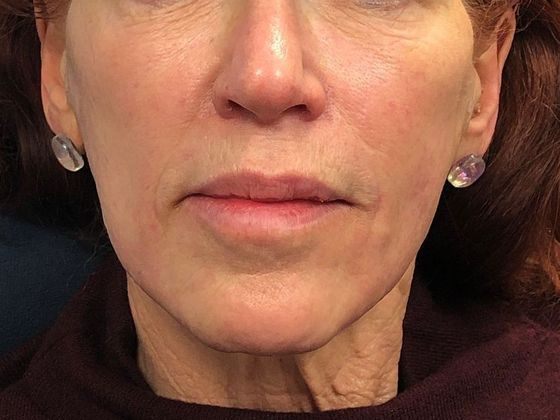 PDO Threads: Case 1 - After