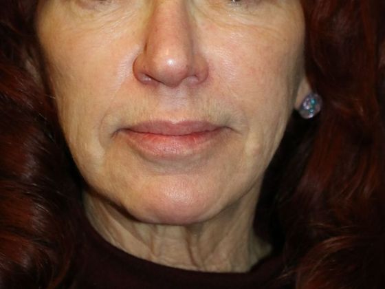 PDO Threads: Case 1 - Before