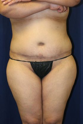Brazilian Butt Lift : Case 4 - Before