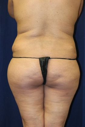 Brazilian Butt Lift : Case 4 - Before