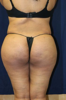 Brazilian Butt Lift : Case 4 - After