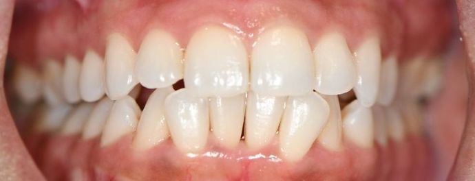 Periodontal Cleaning Case 5 - Victoria, TX - After