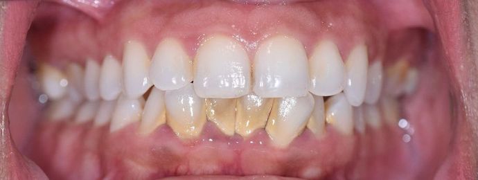 Periodontal Cleaning Case 5 - Victoria, TX - Before