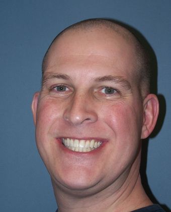 Amazing Smiles: Crowded and Under Bite - After