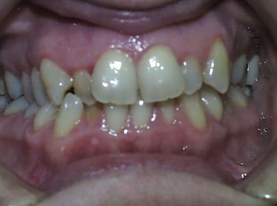 Senior: Senior Crowding - Before