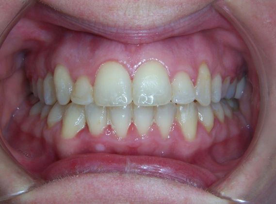 Senior: Senior Crowding - After