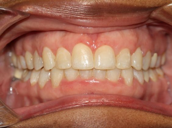 Adult Large Space Tooth Spacing Before And After Gallery 8893