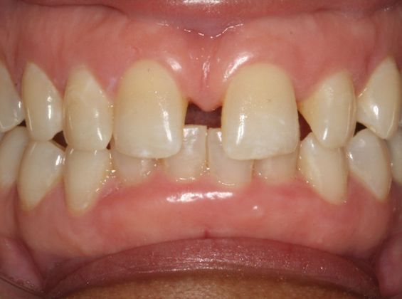 Tooth Spacing Adult Large Space - Before