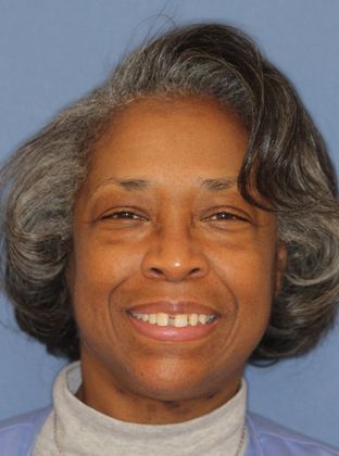 Tooth Spacing: Adult Large Space - Before