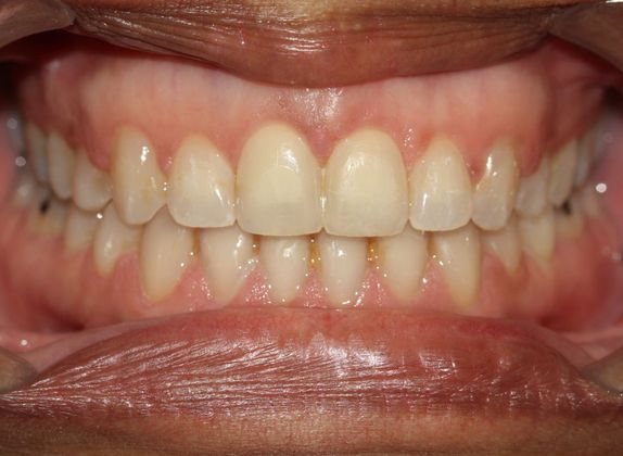 Tooth Spacing: Large Diastema - After