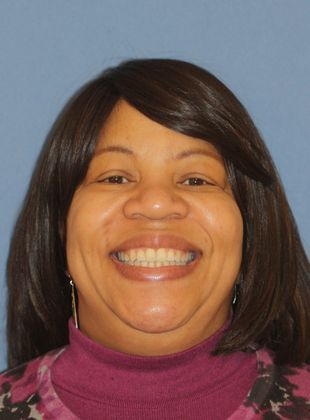 Tooth Spacing Large Diastema  - After