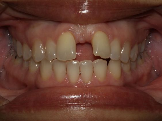 Tooth Spacing: Large Diastema - Before