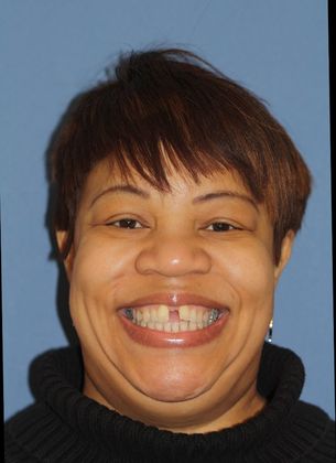 Tooth Spacing Large Diastema  - Before