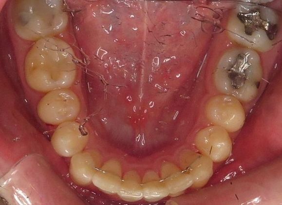 Invisalign - Invisible Braces: Lower Crowding - After
