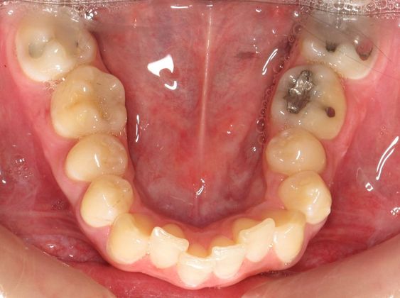 Invisalign - Invisible Braces: Lower Crowding - Before