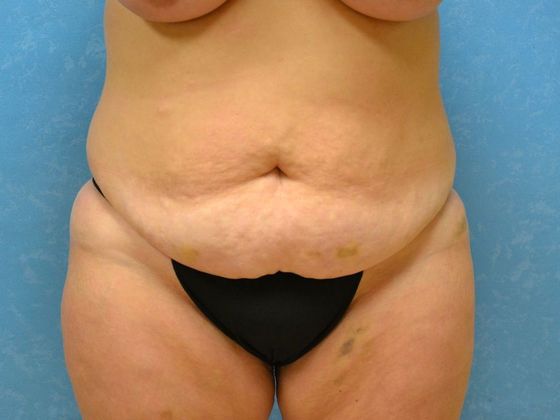 Tummy Tuck Case 1681 - Bryan, OH - Before