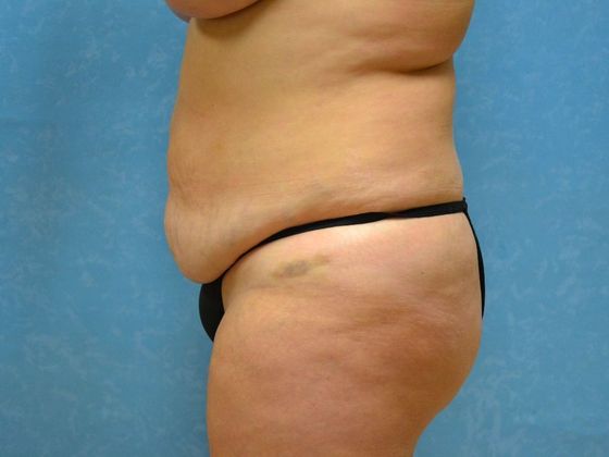Tummy Tuck: Case 1681 - Bryan, OH - Before