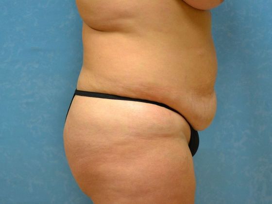Tummy Tuck: Case 1681 - Bryan, OH - Before
