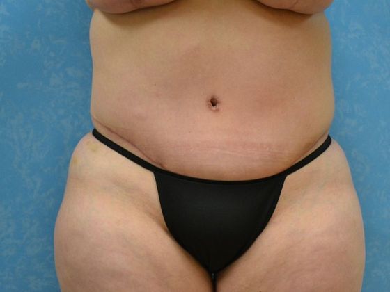 Tummy Tuck Case 1681 - Bryan, OH - After