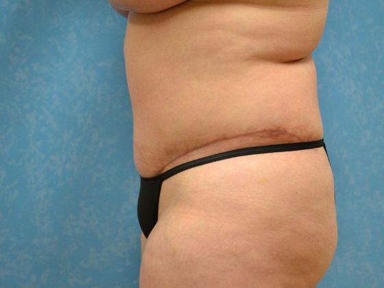Tummy Tuck: Case 1681 - Bryan, OH - After