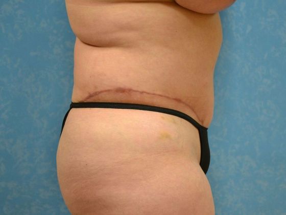 Tummy Tuck: Case 1681 - Bryan, OH - After