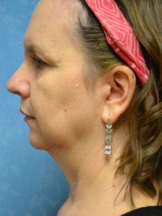 Face & Neck Lifts: Case 1502- Sherwood, OH - Before