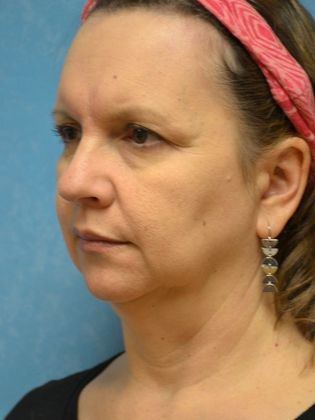 Face & Neck Lifts: Case 1502- Sherwood, OH - Before