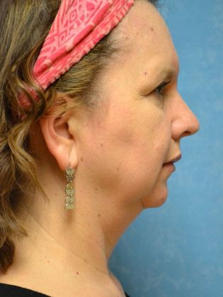 Face & Neck Lifts: Case 1502- Sherwood, OH - Before