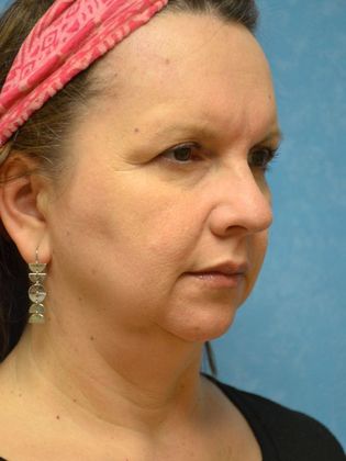 Face & Neck Lifts: Case 1502- Sherwood, OH - Before